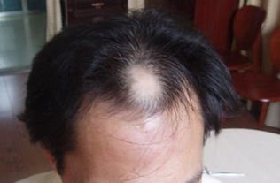莫言高情商回答脱发尴尬，为何脱发也陆续成为了年轻人的困扰？