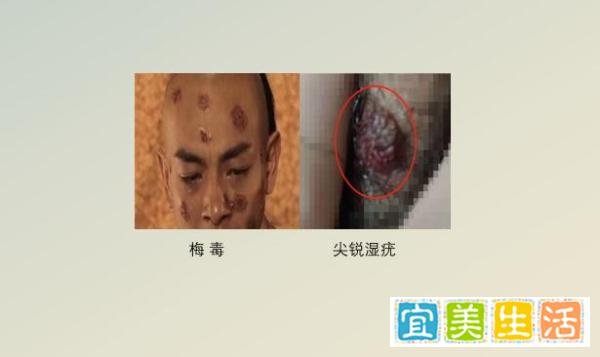 花柳病是什么症状，常见花柳病图片主要有哪几种？