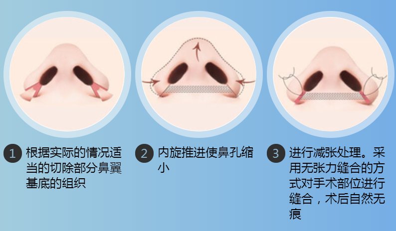鼻头缩小手术大概需要多少钱