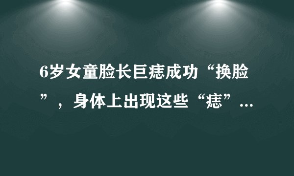 6岁女童脸长巨痣成功“换脸”，身体上出现这些“痣”我们要当心