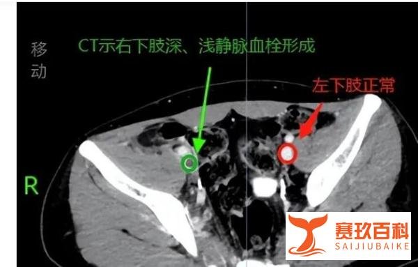 小伙用筋膜枪按摩半小时致静脉血栓与打工女皇回应“2亿年薪”传闻
