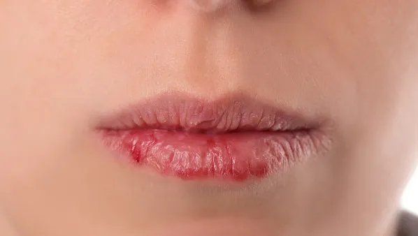 肝火旺的症状