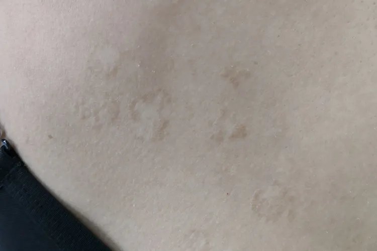 汗癣的症状图片