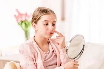 脸上老是长痘痘怎么办 掌握5招教你轻松告别痘痘