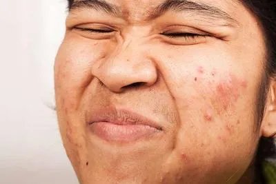 鼻子上长脓包怎么处理