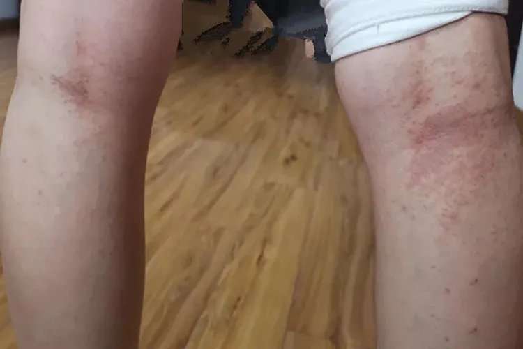 慢性湿疹图片