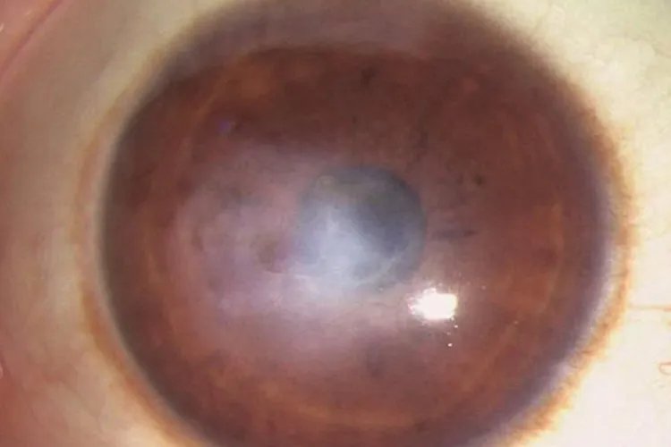角膜炎图片