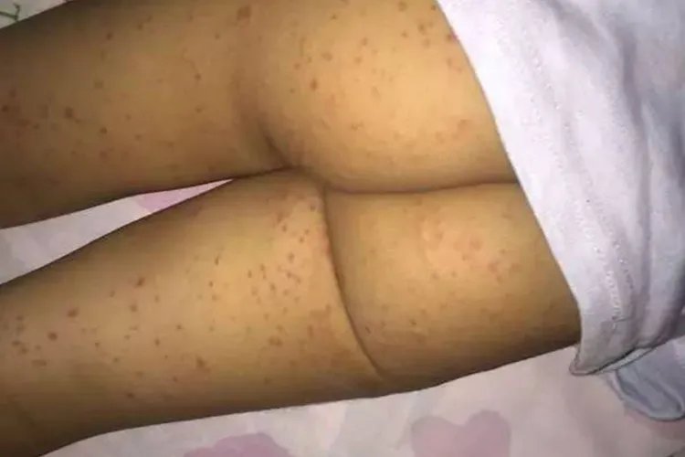 婴儿皮疹图片