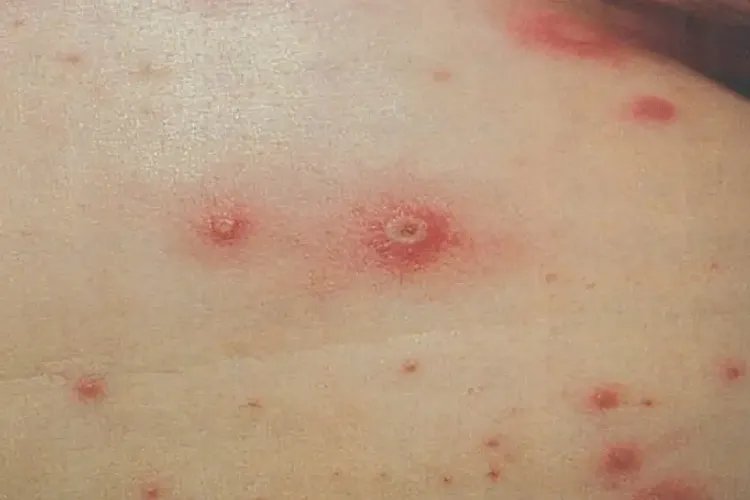 水痘图片大全