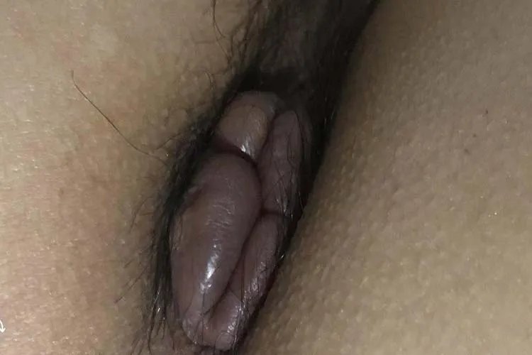 外痔疮的图片