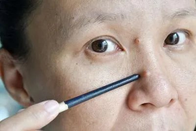 鼻子痤疮的治疗方法