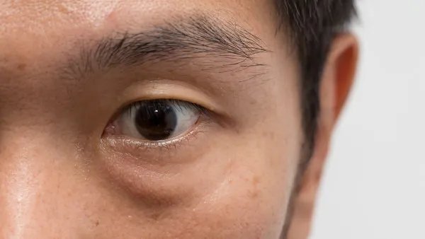 眼袋怎么去掉