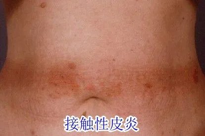 腰部皮肤红斑图片与病症
