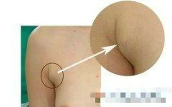 副乳切除多少钱？