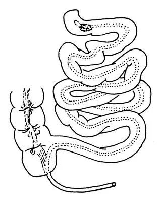 肠粘连症状