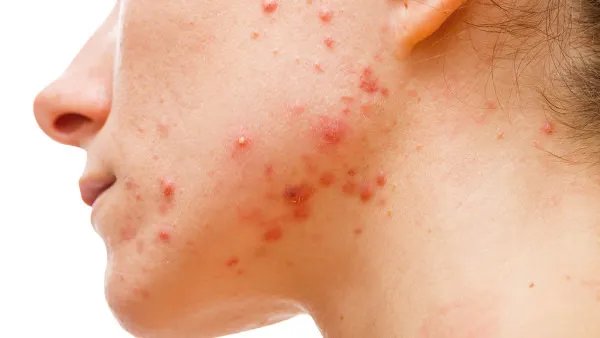 如何去除痘痕