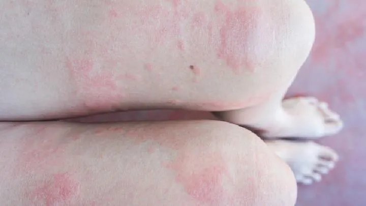 小儿湿疹治疗偏方