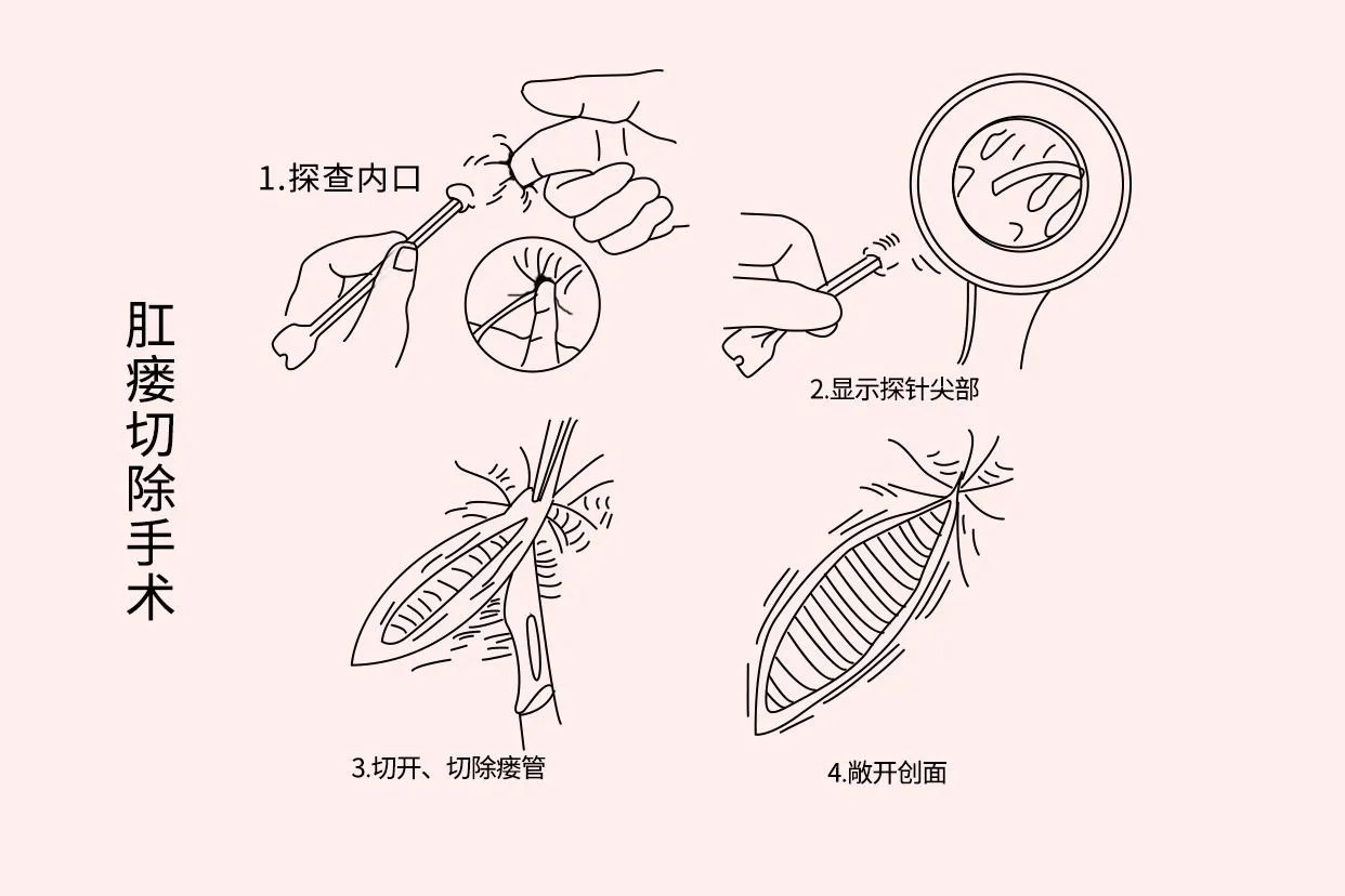 肛瘘手术图片