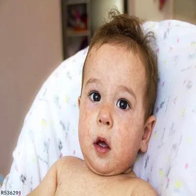 婴幼儿急疹是怎么回事