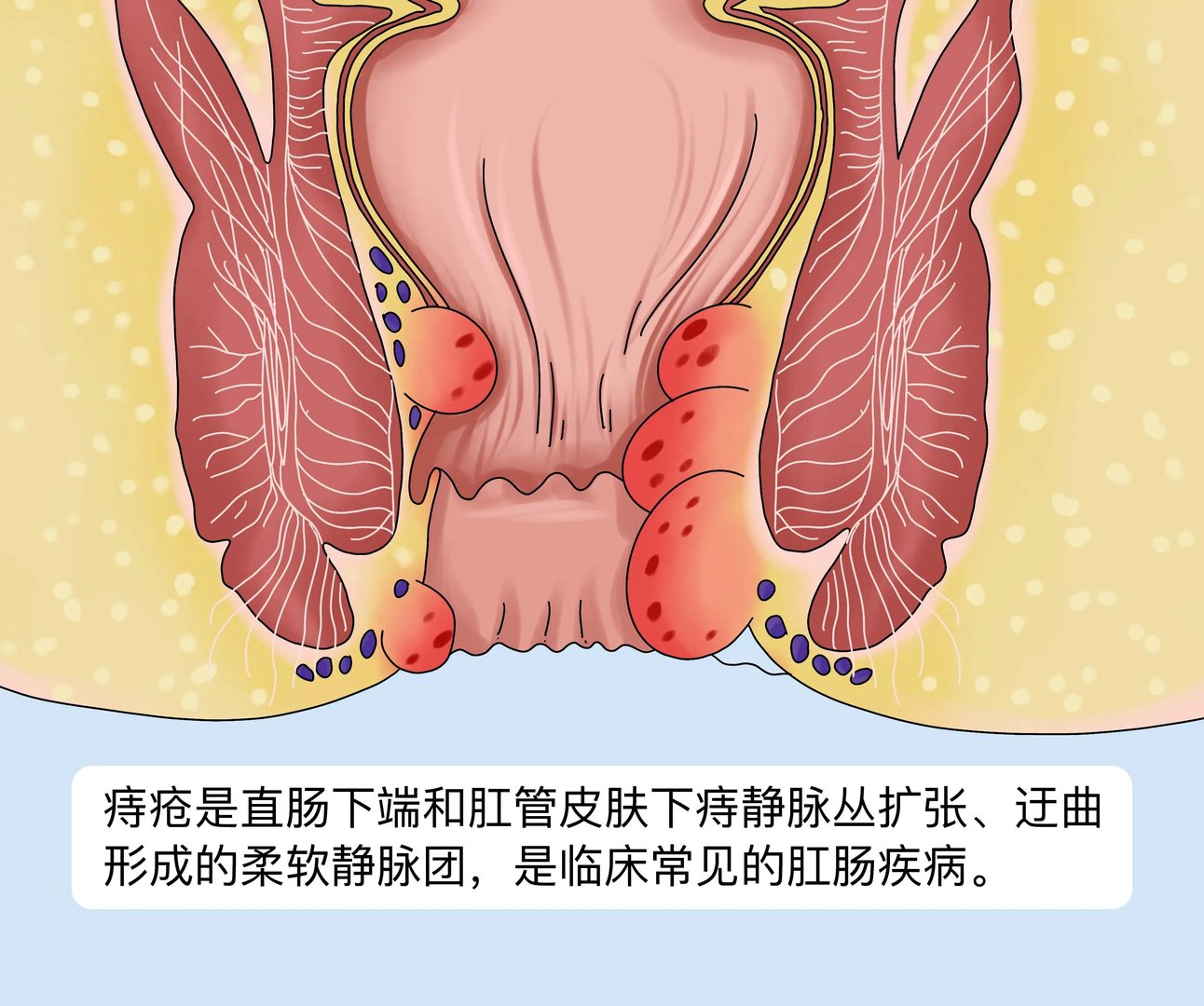 痔疮什么意思