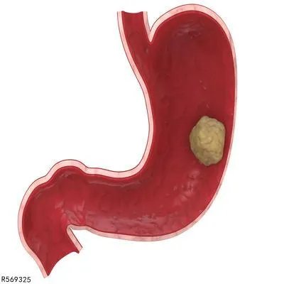 肝胆管结石怎么预防