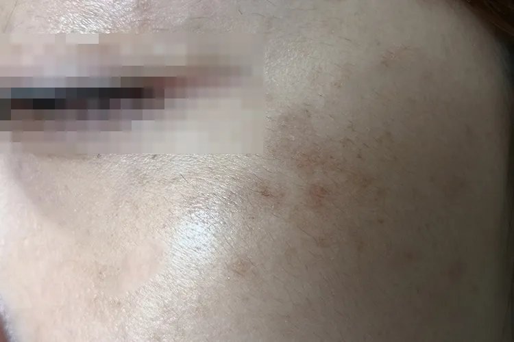 女性长斑的位置图解