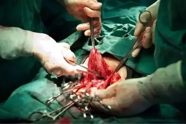 剖腹产图片