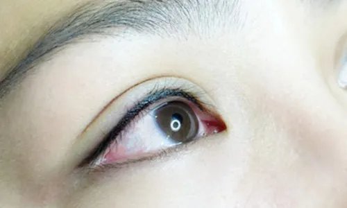 北京双眼皮修复手术价格