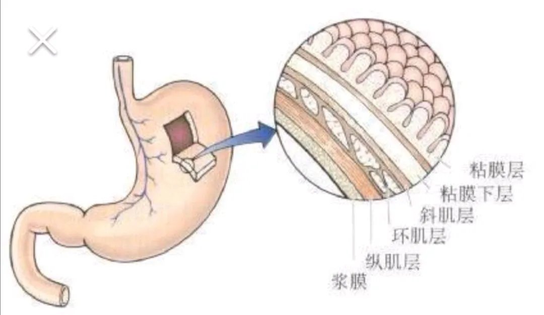 消化性溃疡