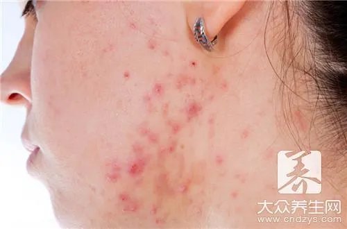粉刺瘤扎破挤出能好吗