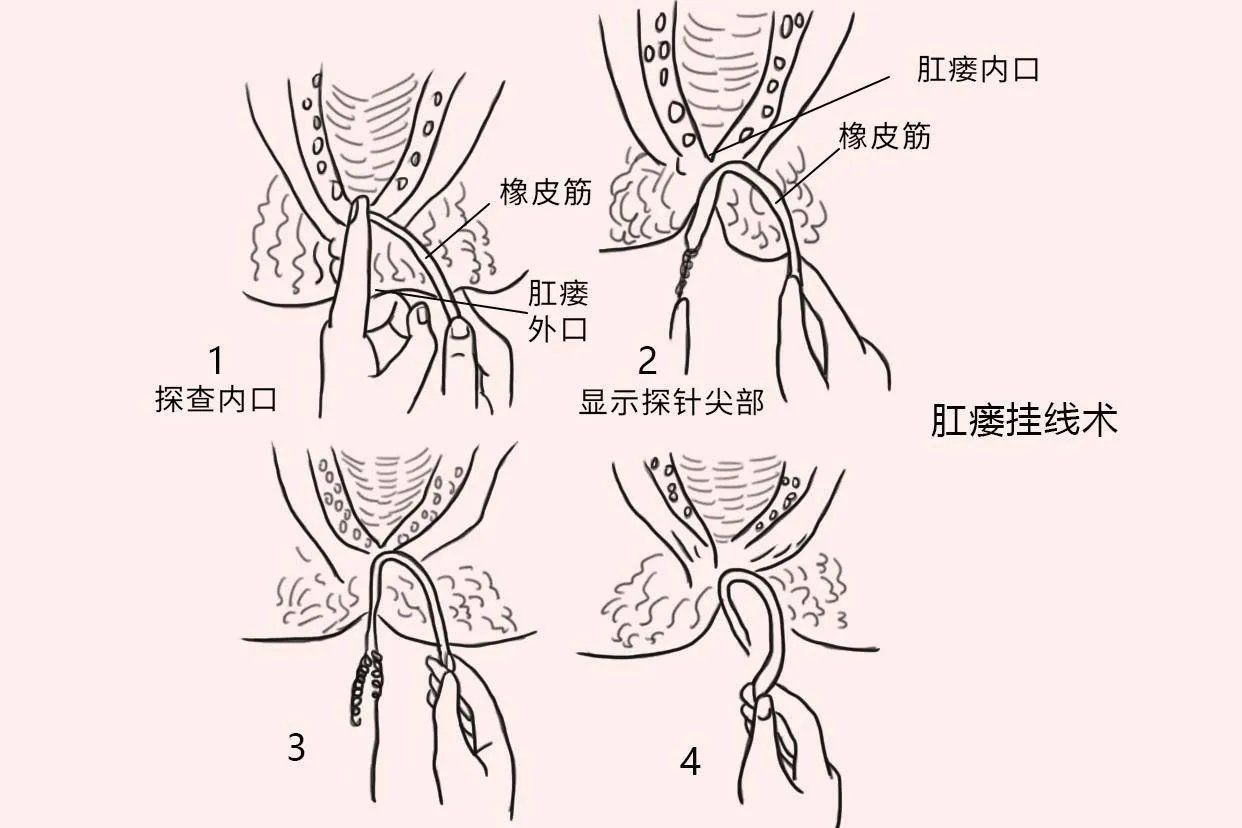 肛瘘手术图片