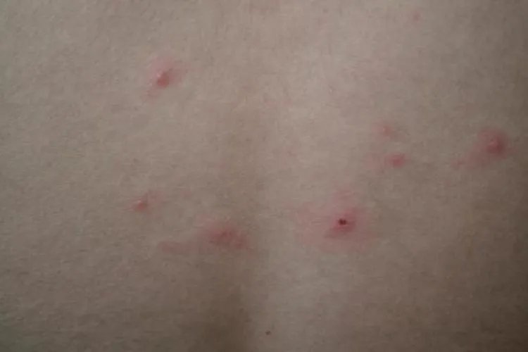长水痘图片