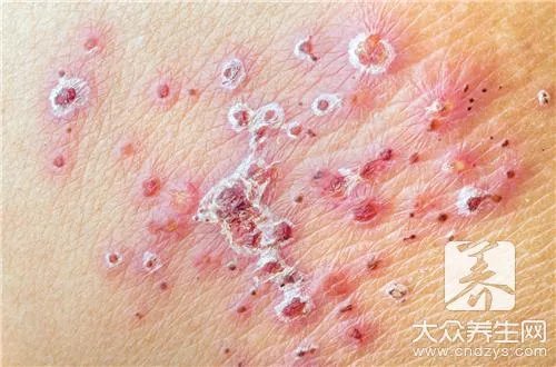 丘疹型荨麻疹的病因是什么