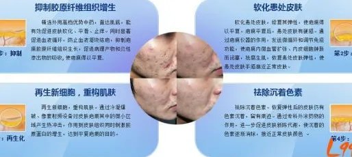 凹陷性疤痕