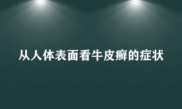从人体表面看牛皮癣的症状