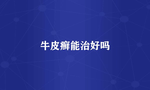 牛皮癣能治好吗