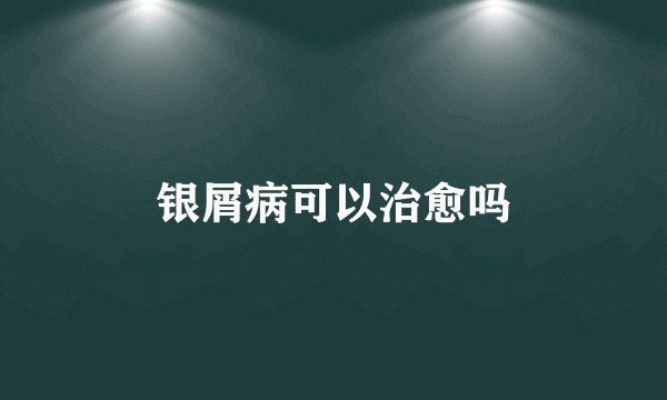 银屑病可以治愈吗