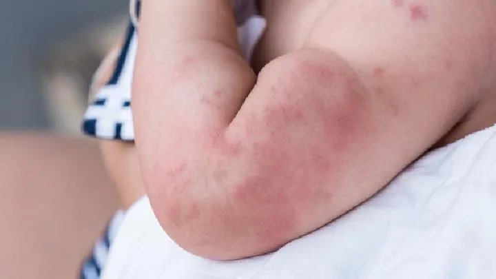 荨麻疹的治疗方法有哪些?