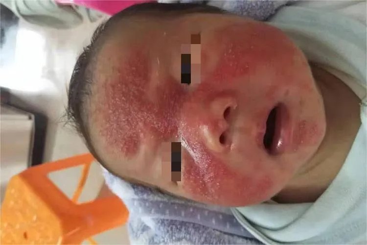 各种面部皮炎症状图片大全