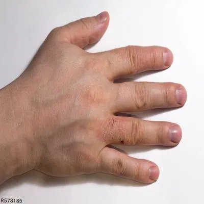 色素性紫癜严重的会怎么样