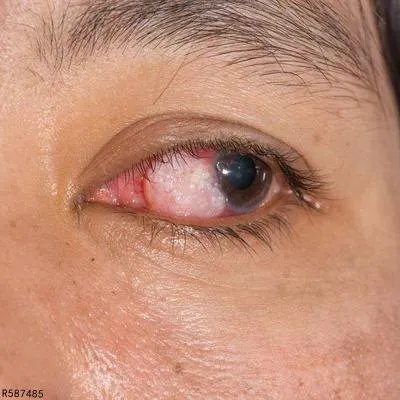 眼结膜下出血的发病原因有哪些