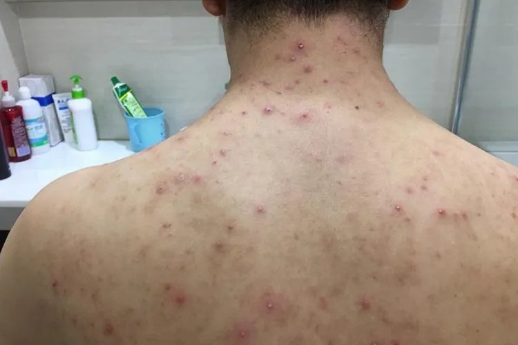 男人后背长痘痘图片
