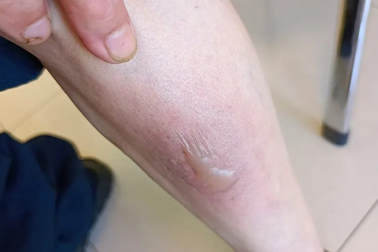 皮炎的10种症状图片