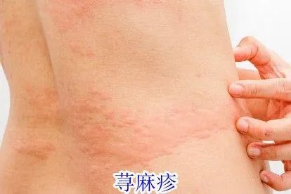 腰部皮肤红斑图片与病症