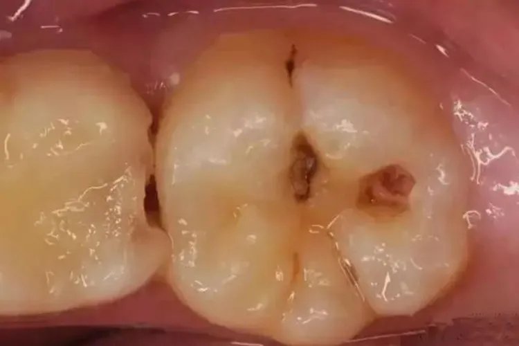 大牙虫牙图片