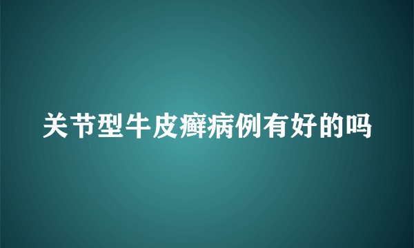 关节型牛皮癣病例有好的吗