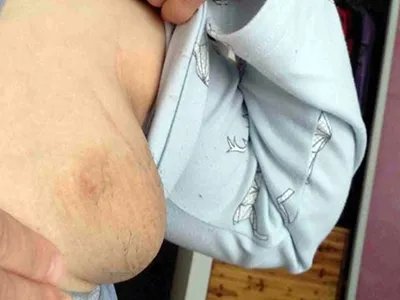 副乳症状图片