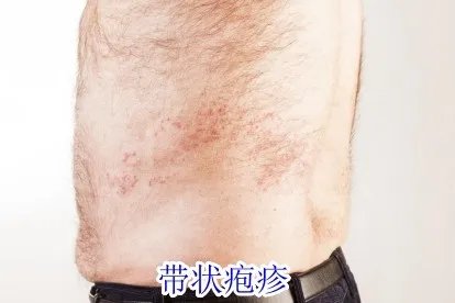 腰部皮肤红斑图片与病症