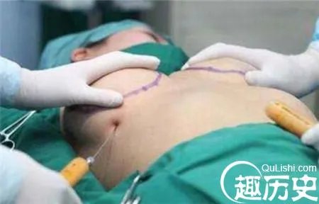 整容变毁容！女子隆胸像茄子严重变形超级难看
