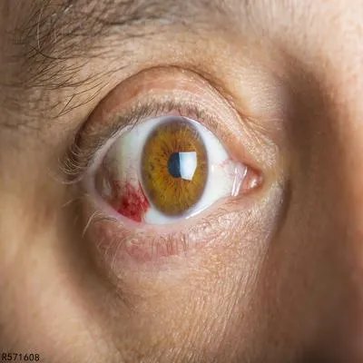 红眼病怎么治 治疗红眼病这三种方法有效